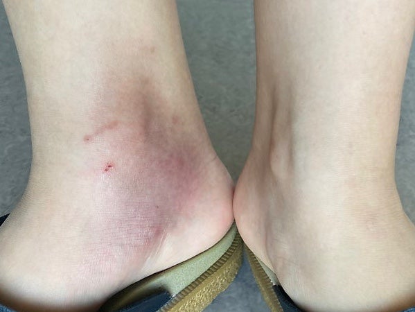 성인 모기알레르기 스키터 증후군 병원 피부과 처방약
