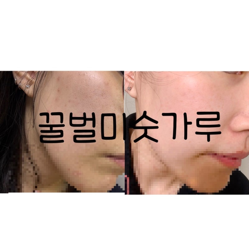 더마팩토리 나이아신아마이드 20% 세럼 후기 확연한 비포 애프터 차이(사진 있음) 민감성, 여....