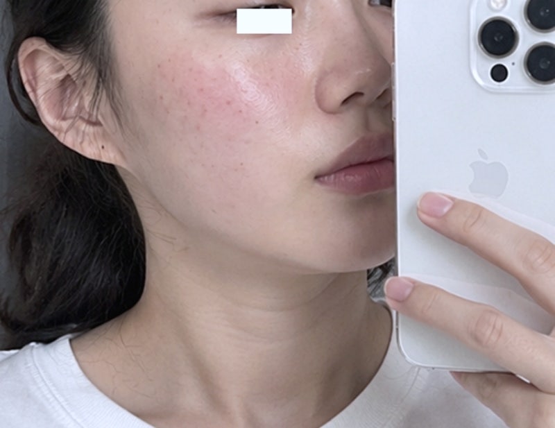에스로반 연고 마데카솔 후시딘이랑 다른점 상처 붉어짐 피부염증 고민