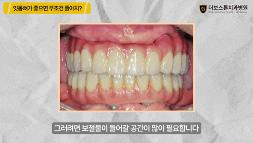 천안치과병원 풀아치임플란트, 무조건 좋을까?