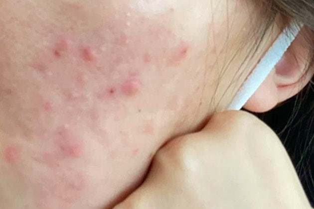 가려운 얼굴 접촉성 피부염 연고 리도맥스 대체한 크림 관리법