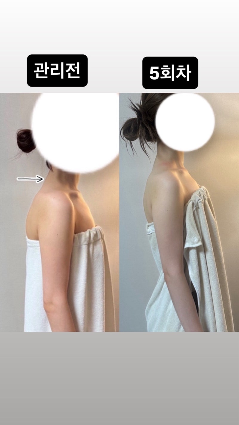 해운대 장산 거북목 교정마사지, 라운드숄더와 뻐근한 어깨 관리