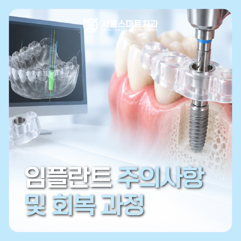 송도 임플란트, 임플란트 수술 후 주의사항 및 회복과정