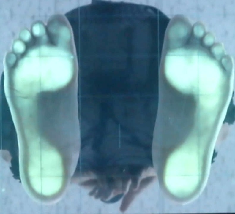 80대 양쪽 뒤꿈치 통증, 오래 걸어온 발에서 나타난 보행 변화