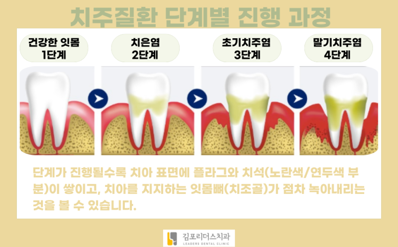 구래동 치과, 급성 치주염 만성 치주염의 차이점부터 잇몸 치료방법