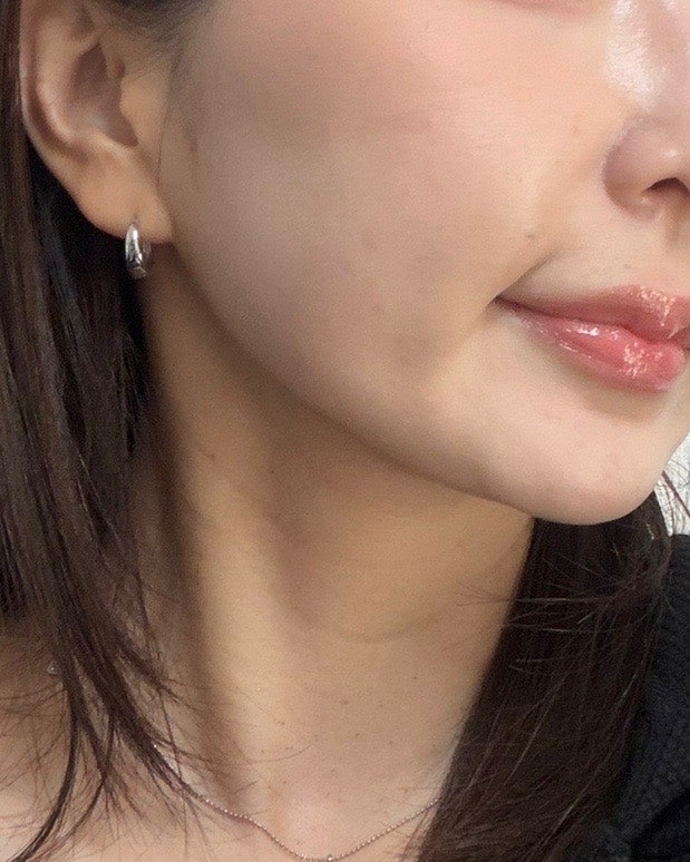 부산편평사마귀성지 서면 편평사마귀 무제한 얼굴 목 후기