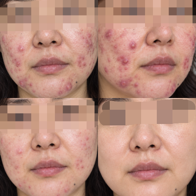 누르면 아픈 안짜지는 여드름 염증주사없이 집에서 해결하는 관리 루틴