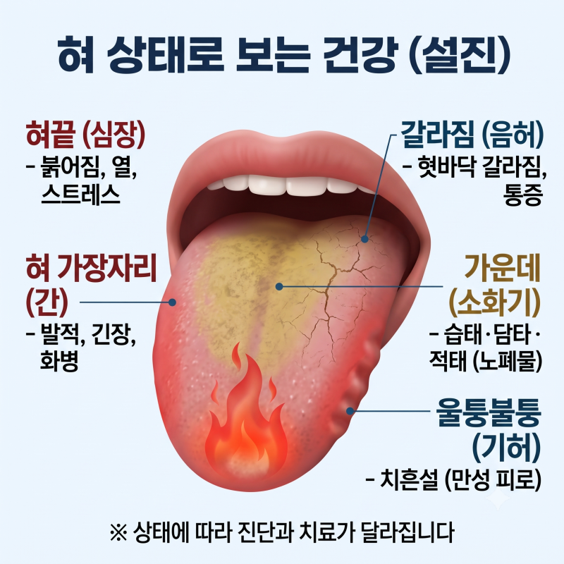 구강작열감증후군 혀통증 혀작열감 증상 원인 치료