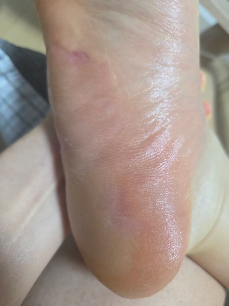 발 각질로 고민이 많다면 들어오세요-각화형무좀,발건선,발습진