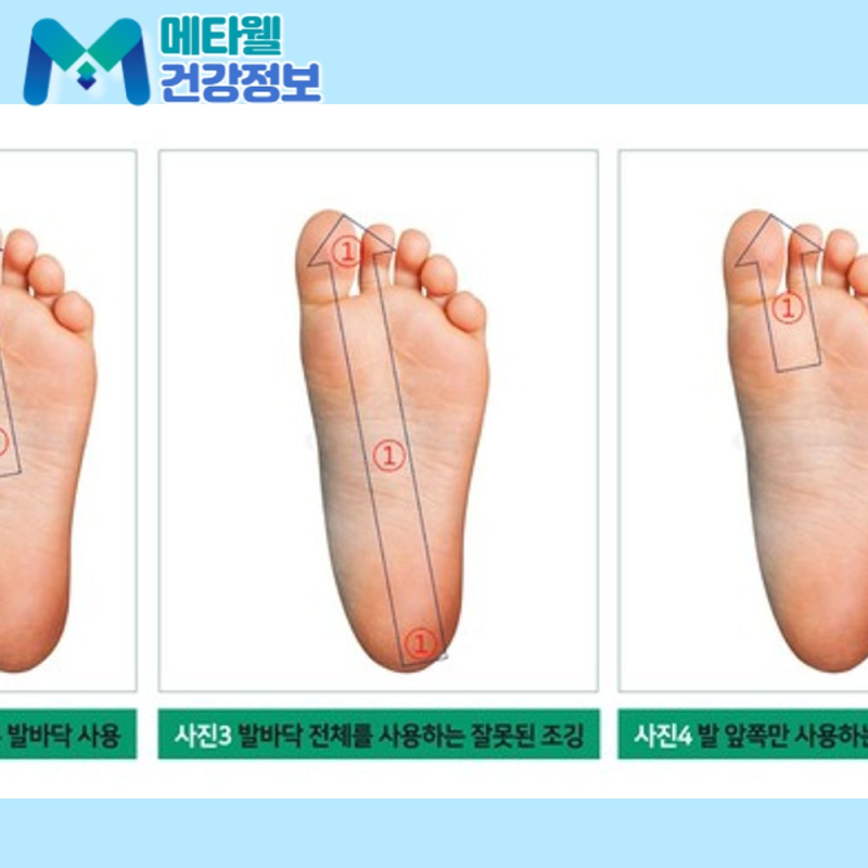 발바닥 점과 흑색종을 가르는 ABCDE 기준