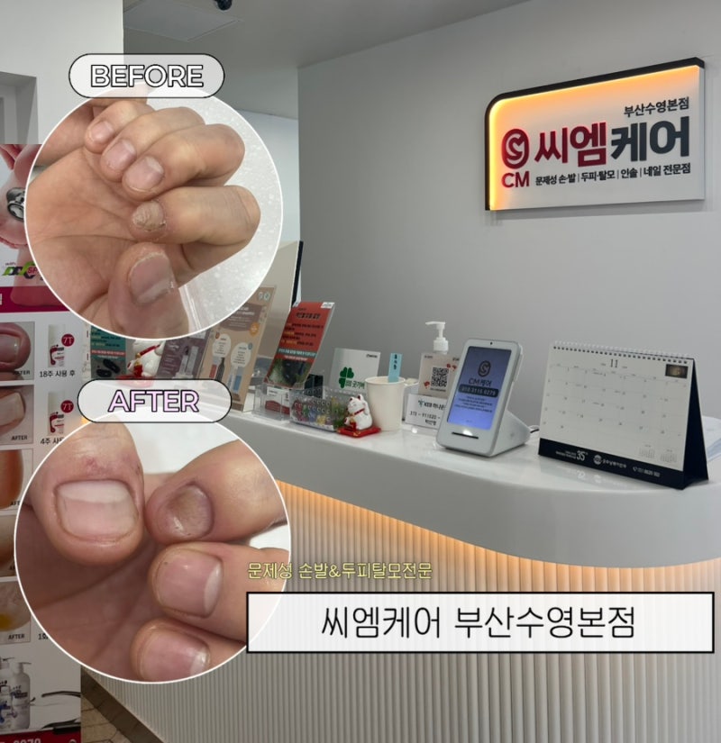 수영역에서받는 맞춤발관리케어,부산문제성손톱 물어뜯는손톱관리후기 씨엠케어 부산수영....
