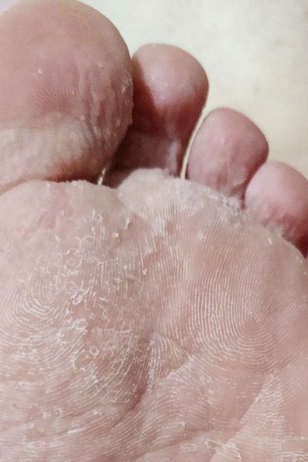 라미실크림 테르비나핀 1% 발가락 사이 무좀 빠른 회복방법