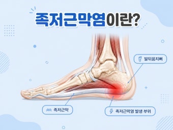 [발 건강 가이드] 걸을 때 발바닥·뒤꿈치가 찌릿? 스케쳐스 vs 호카 운동화 족저근막염 완화 ....