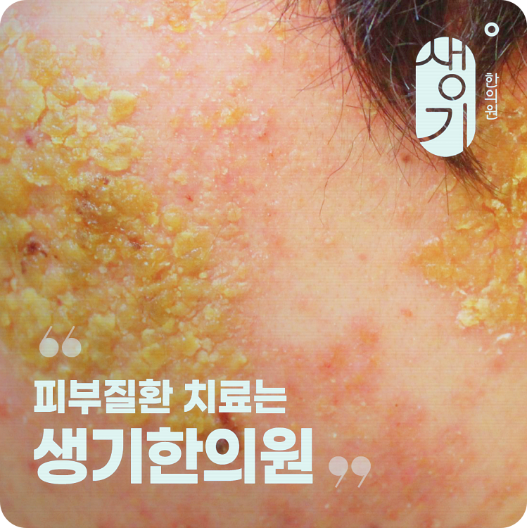 모낭염 연고, 증상에 따라 사용하는 방법도 달라질까?