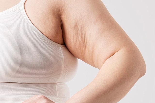 복부지방분해주사와 지방분해약침 | 셀룰라이트제거 및 똥배빼는법 알려드려요 (잠실 삼전....