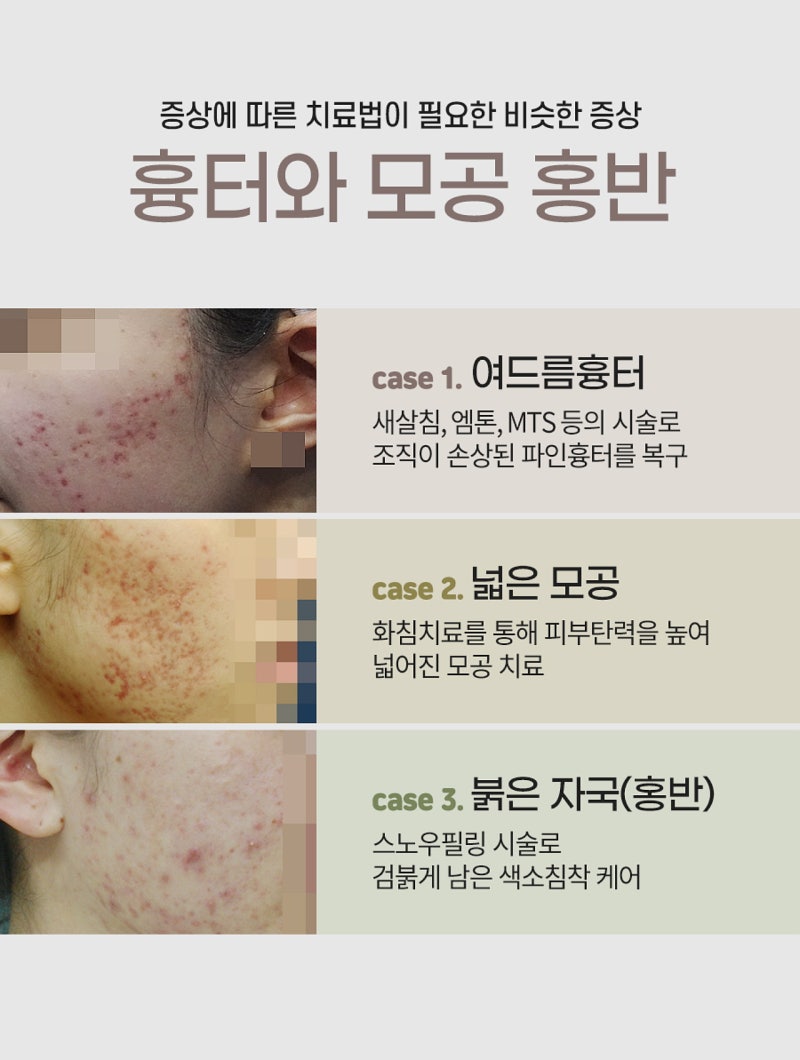 안산여드름흉터한방피부과병원추천, 여드름자국 신경쓰인다면