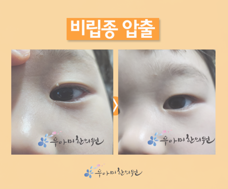 비립종 압출을 원했던 환자, 바로 압출하지 않았습니다