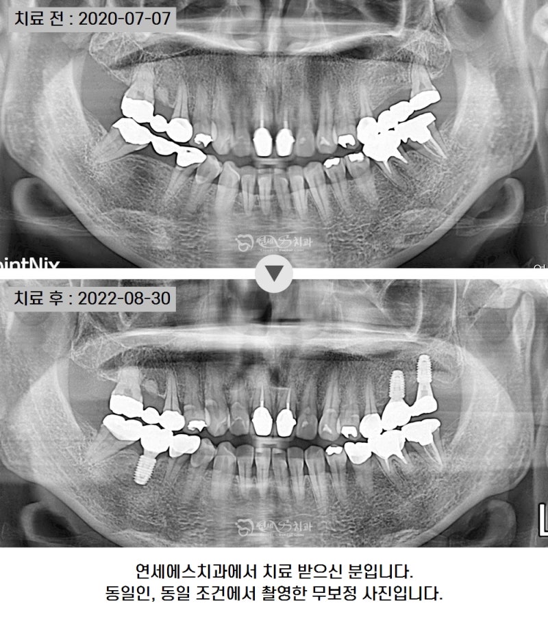 어금니가 흔들려요 씹을 때 브릿지 욱신 통증, 임플란트로 교체