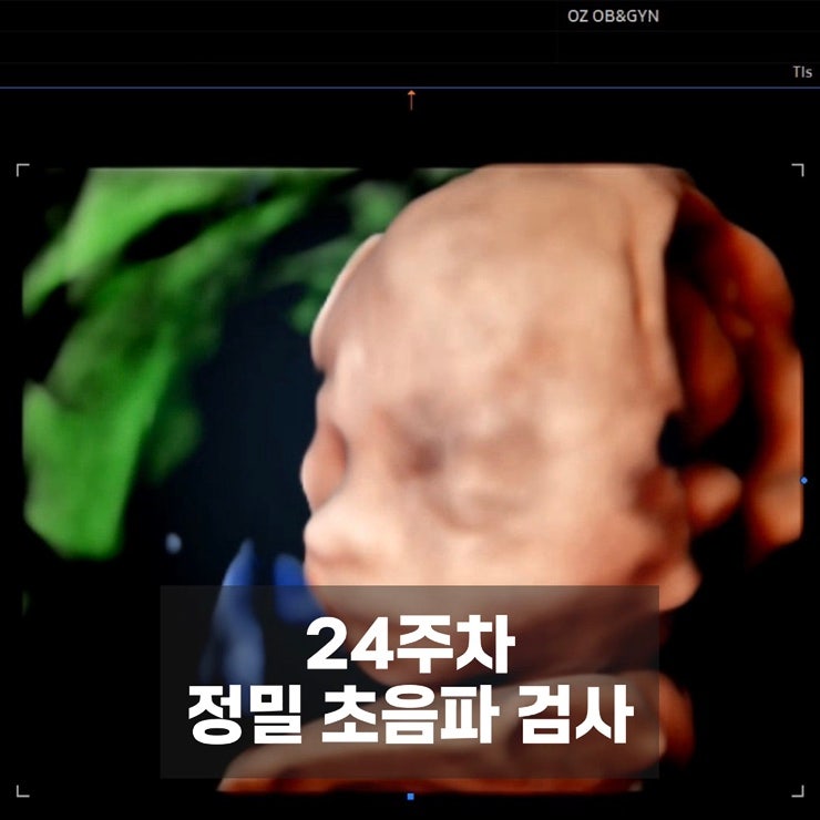 [임신일기] 20주차 정밀초음파 후기 및 임산부의 건강검진 결과 후기