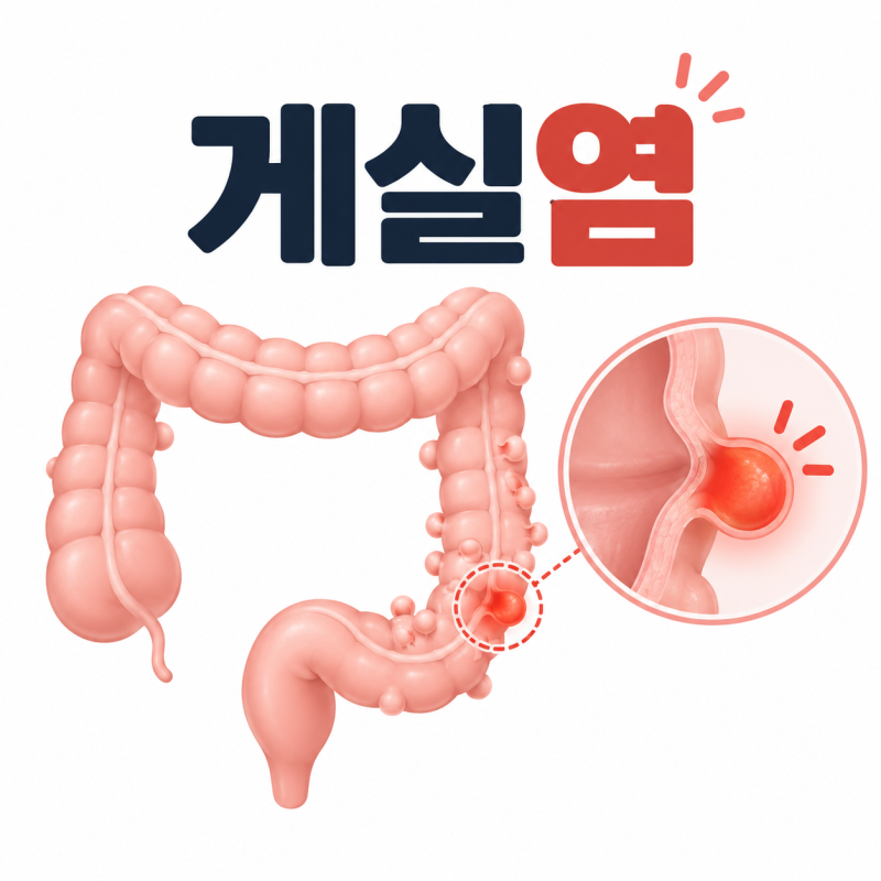 [대장항문] 게실염 (Diverticulitis)