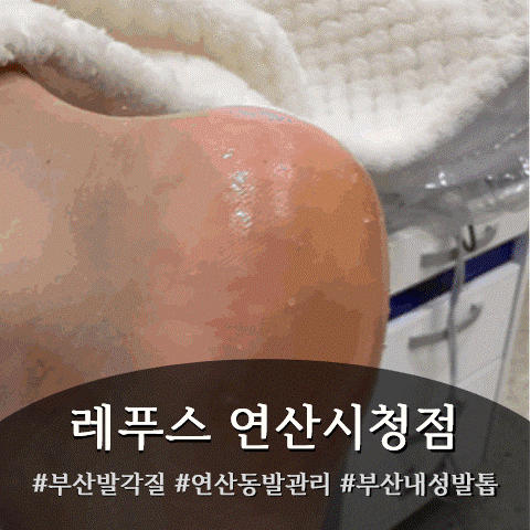 부산레푸스 연산시청점 부산발각질 제거 후기, 족압측정까지 (부산내성발톱·부산발톱무좀 ....