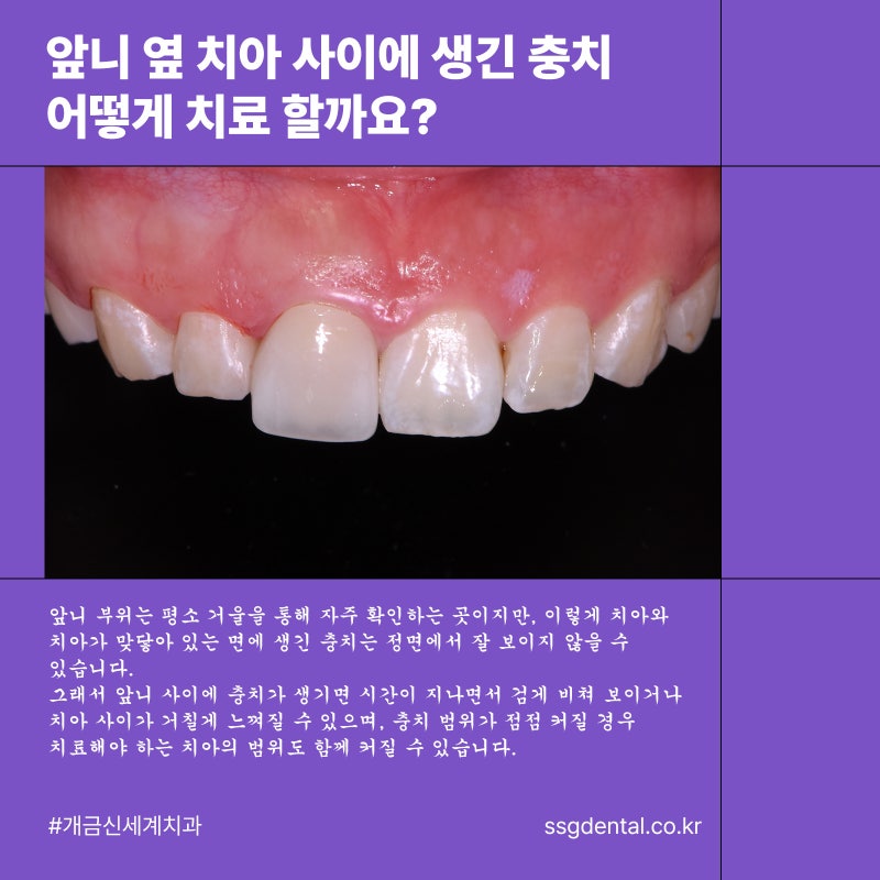 주례 럭키 아파트 앞니 옆 치아 사이에 생긴 충치 어떻게 치료할까요?