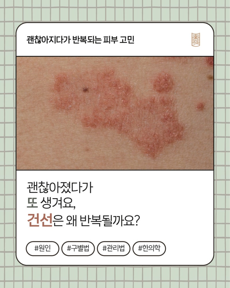 괜찮아졌다가 또 생겨요, 건선은 왜 반복될까요?