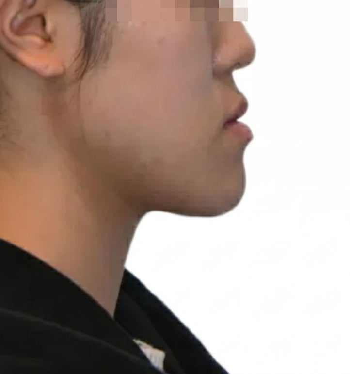 네? 주걱턱은 수술 하라고요? 비수술 교정기 후기