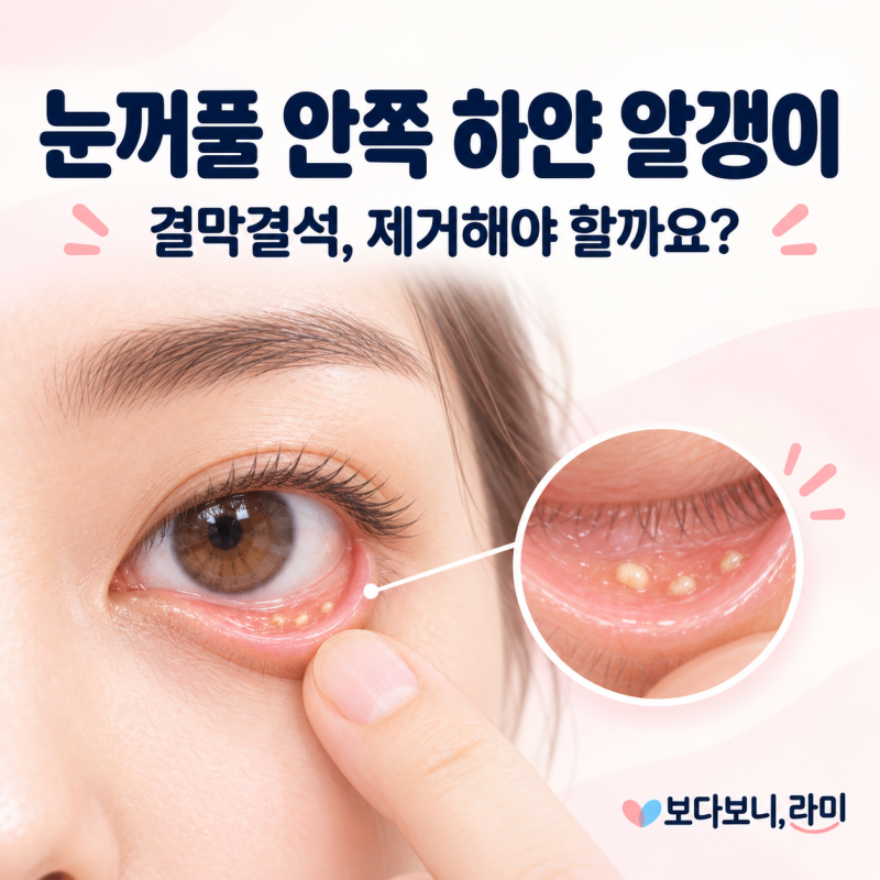눈꺼풀 안쪽 하얀 알갱이, 결막결석 원인과 제거해야 하는 경우