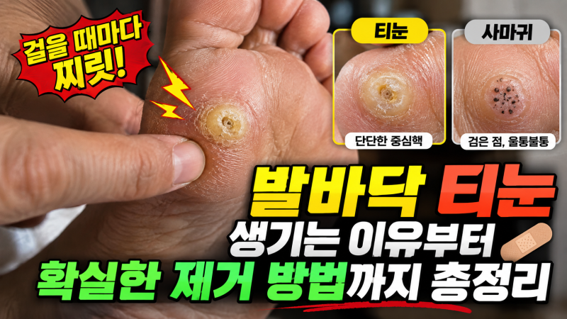 ⚡걸을 때마다 찌릿! 발바닥 티눈 생기는 이유부터 확실한 제거 방법까지 총정리 (ft. 사마....