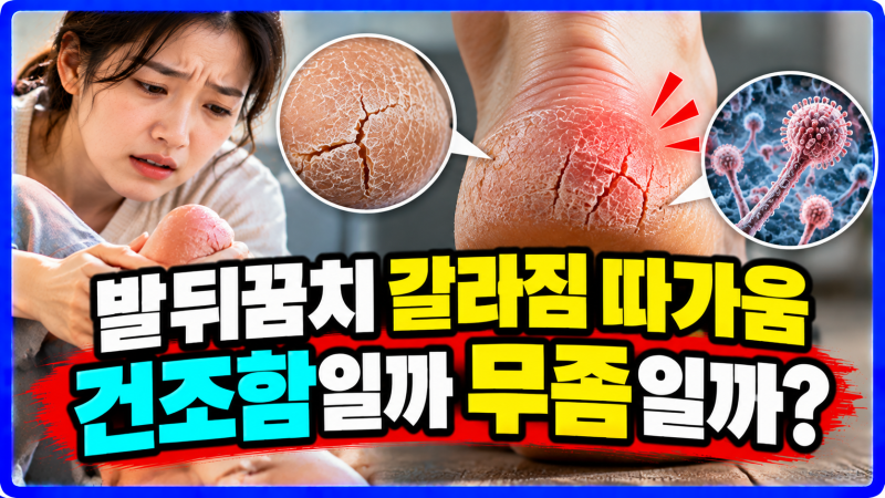 단순 건조함일까 무좀일까? 발뒤꿈치 갈라짐 따가움 원인과 보습 케어 꿀팁