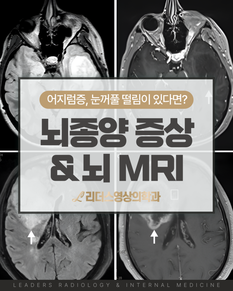 어지럽고 눈꺼풀 떨림 있으면 뇌종양 증상일까? ? MRI로 상태 확인 (영상의학과 뇌 검사)