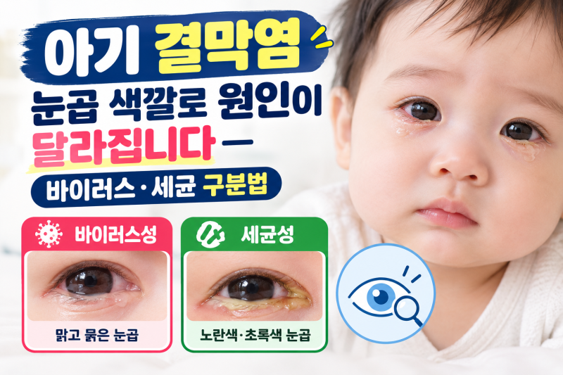 아기결막염 눈곱 색깔로 원인이 달라집니다 — 바이러스·세균 구분법