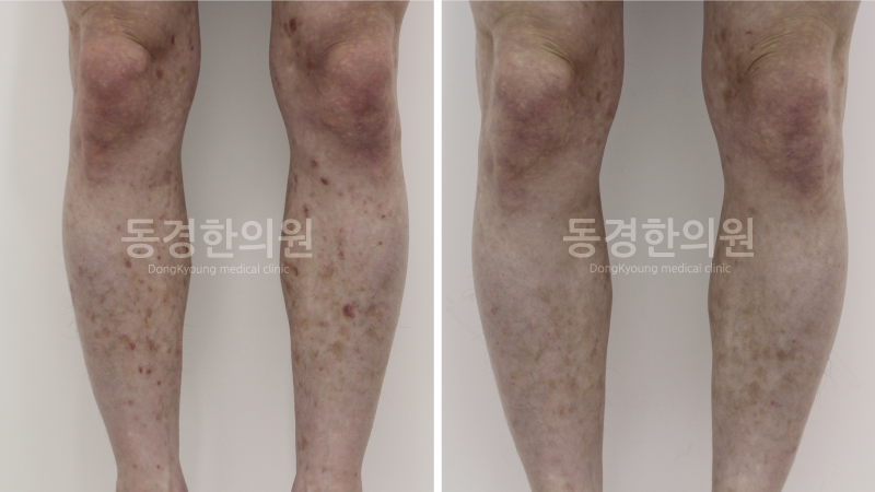 만성 혈소판 감소증 원인 치료 시급하다면 필독