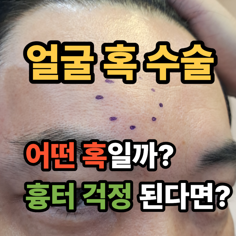 얼굴 혹 만져진다면? 피지낭종 지방종 어떤 혹일까?
