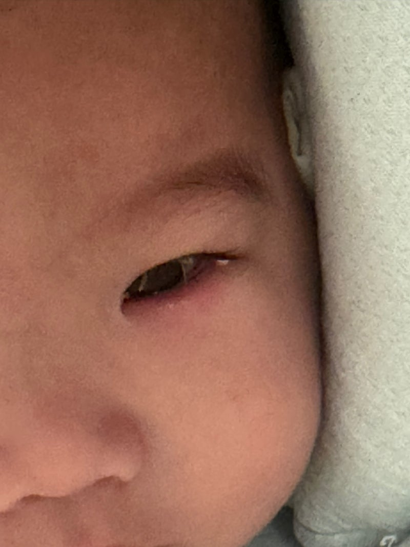 126일 아기 다래끼｜예방접종 다음 날 눈이 부었어요, 눈물샘 막힘으로 생긴 염증