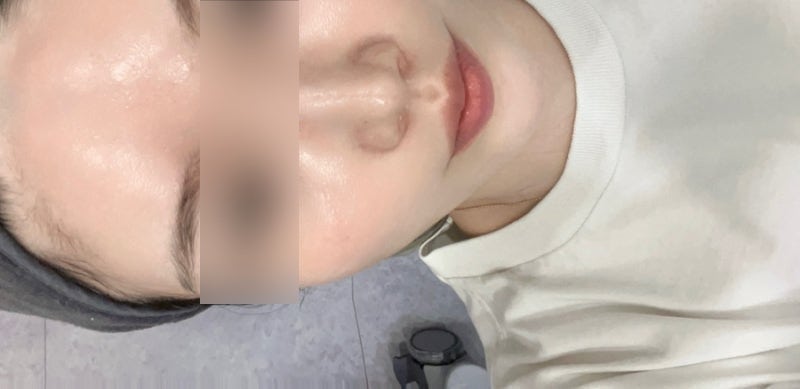 신사 스킨부스터 추천, PDRN 물광 듀얼젠 스킨부스터, 솔직후기 (가격 부작용 통증)