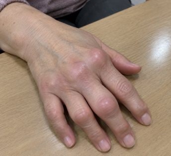 손가락 관절 통증으로, 다이소 손가락 보호대 등 시도한 방법 (지금은 관절염에서 벗어났어....