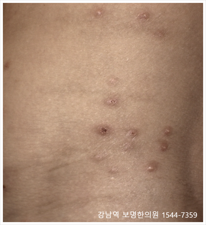 "피부 오돌토돌" 원인, 편평사마귀 물사마귀 두드러기 어떻게 다를까요?
