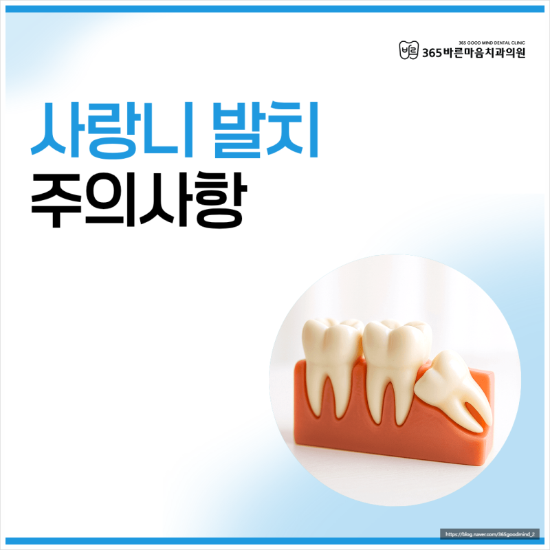 광주 치과에서 설명하는 사랑니 발치 후 흡연과 음주, 정말 안 돼요?