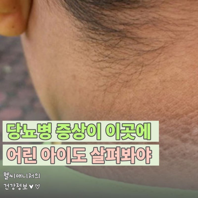 '여기'를 보면 혈당수치 정상인지 알 수 있다? 당뇨 초기증상 피부로 확인하는 법