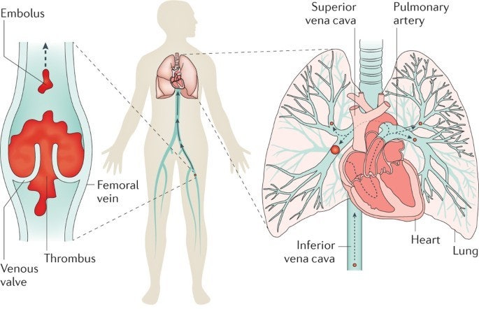 폐색전증 Pulmonary embolism/thromboembolism: 폐색전증·정맥혈전색전증 의료진·의료기관 플랫폼