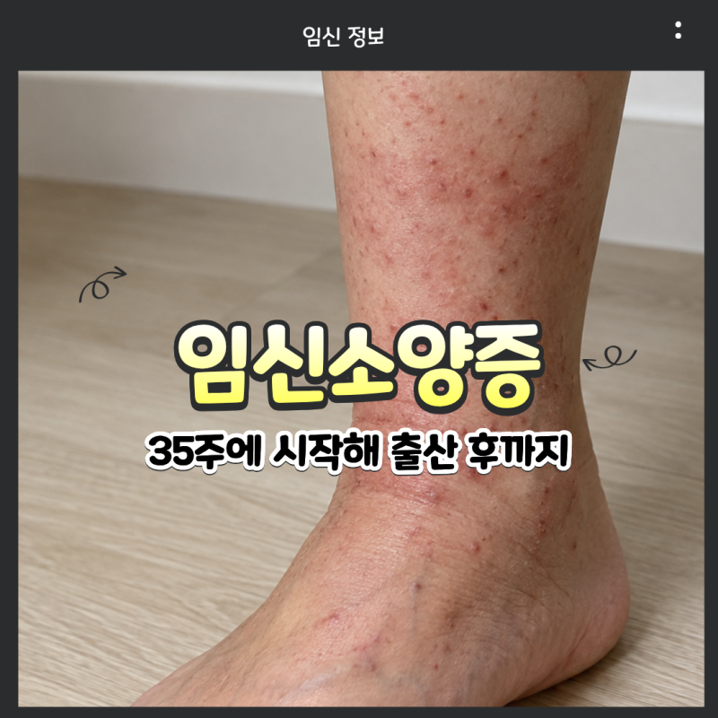 임신소양증 증상 언제부터? 35주에 시작해 출산 후까지 겪은 후기