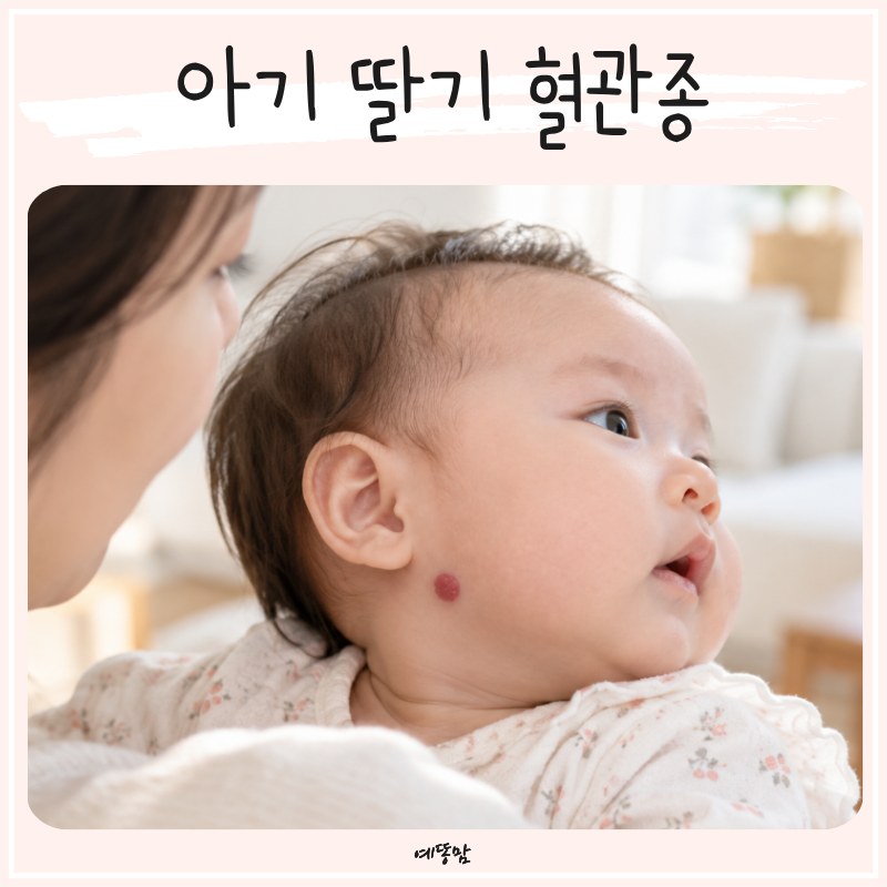 신생아 피부 딸기 혈관종, 아기에게 생기는 원인과 치료 방법
