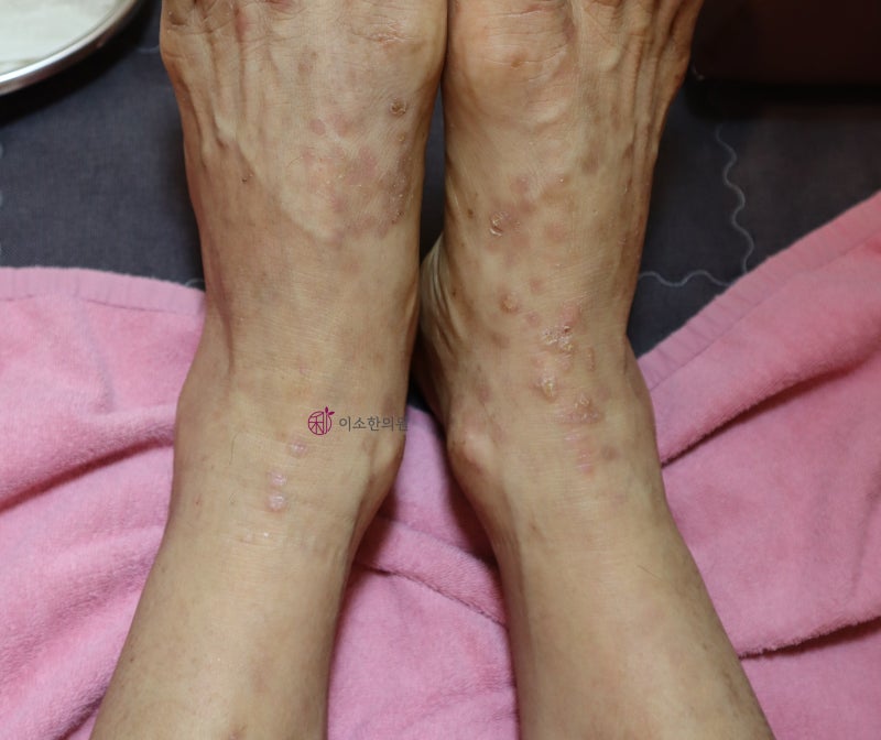 피부 가려움증, 좁쌀 발진, 전염되는 옴, 전염되지 않는 양진, 결절성양진
