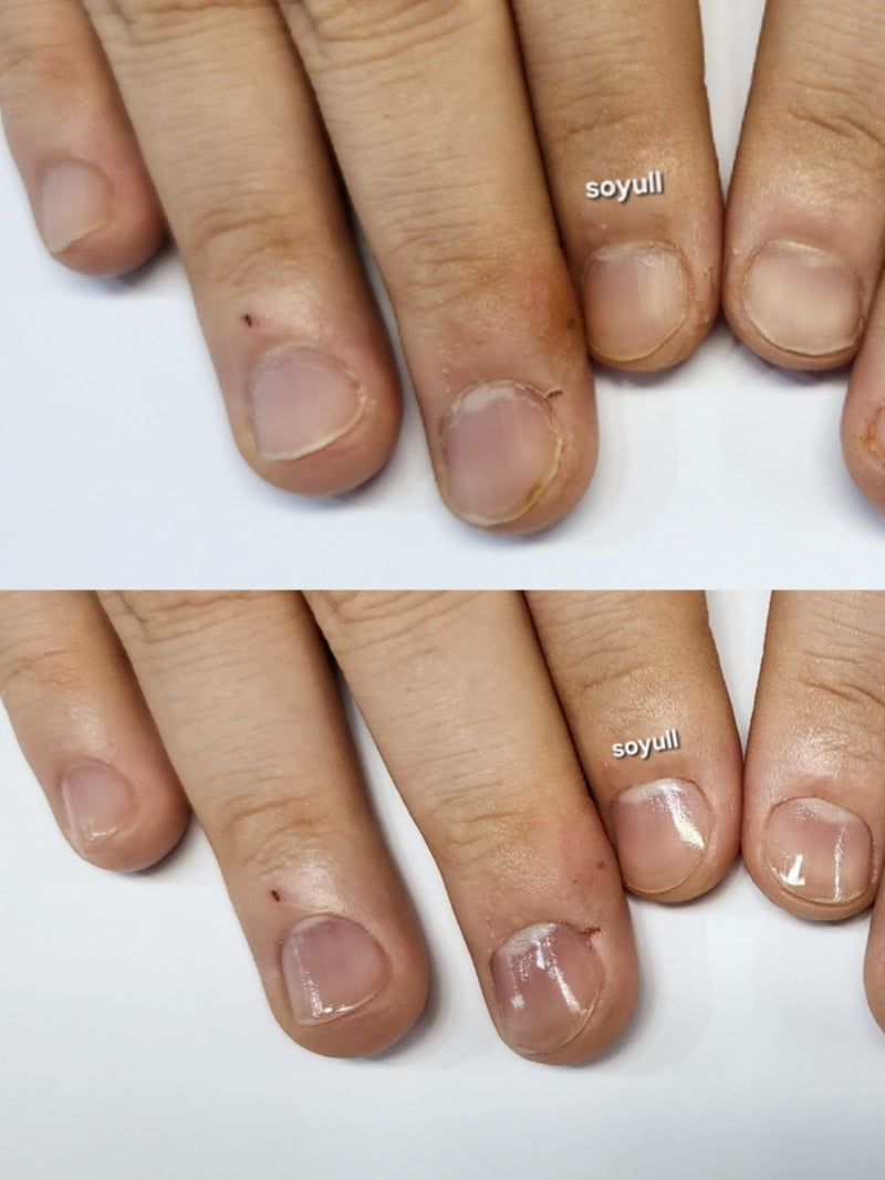 [인천 손톱교정] 남자 물어뜯는 손톱 교정, 3주 꾹 참고 방문하신 고객님 문제성 케어 후기!!