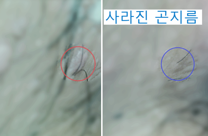 사타구니 곤지름 완치, 원인을 알아야 재발을 잡는다