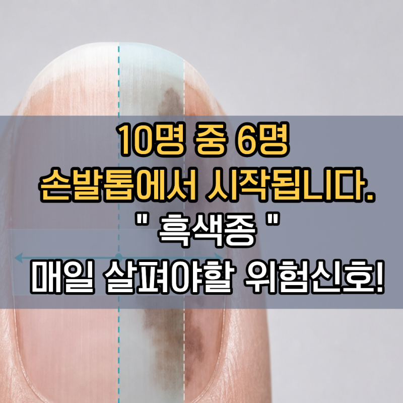 "흑색종의 10명 중 6명이 손발톱에서 시작됩니다!, 매일 살펴야 할 위험신호 7가지 | 손톱 검은....