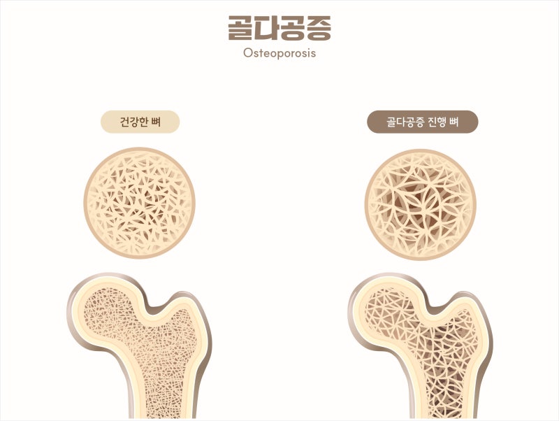 골다공증 예방 영양제 조합은? 칼슘만 먹으면 안 되는 이유