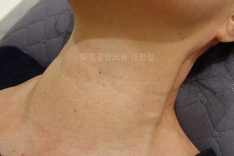 대전편평사마귀제거) 60대 여성의 목 편평사마귀 제거 케이스 1례.